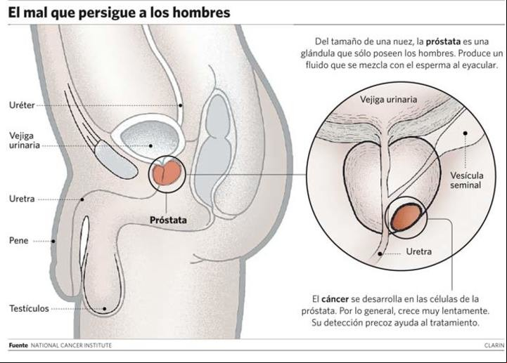 Cáncer de próstata. El mal que persigue a los hombres.
