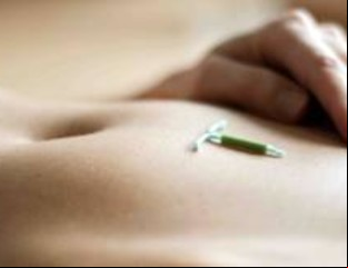 Polémica, pros y contras del DIU que libera hormonas