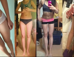 ¿Es sexy el "thigh gap"? El espacio entre muslos, la última obsesión adolescente