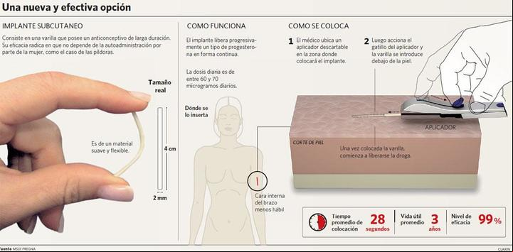 Chip anticonceptivo. Cómo se coloca, cómo funciona. Infografía Clarín.