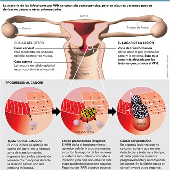 Cáncer de cuello de útero: una enfermedad que se puede evitar