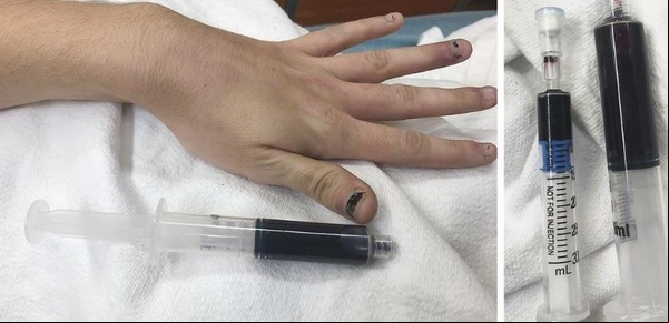 Le dolía la muela, se automedicó y su sangre se volvió azul