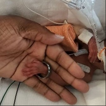 El milagro de la niña más pequeña que una Barbie: sobrevive después de pesar 370 gramos
