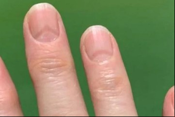 Descubrieron que el Covid deja huellas en las uñas