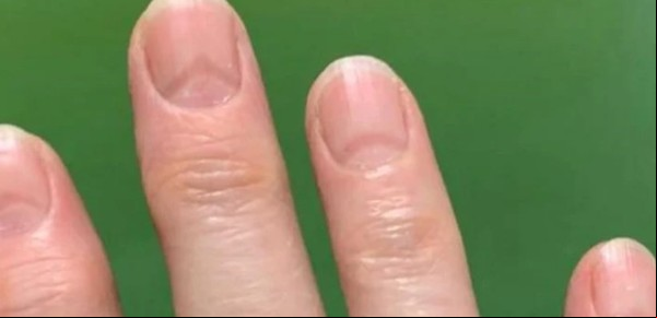 Descubrieron que el Covid deja huellas en las uñas
