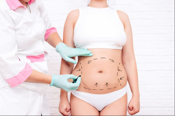 La liposucción fue la cirugía estética más realizada en 2021. Foto Shutterstock.