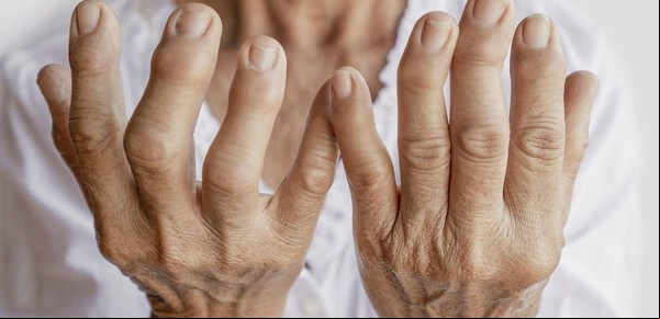¿Hay una vacuna para combatir la artritis reumatoide?