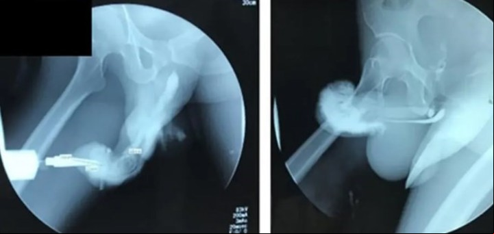 Radiografía de la fractura del pene.