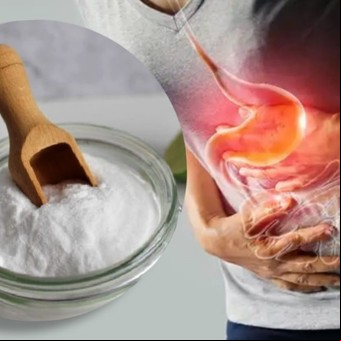 Cómo se debe tomar el bicarbonato de sodio para la gastritis o la acidez 