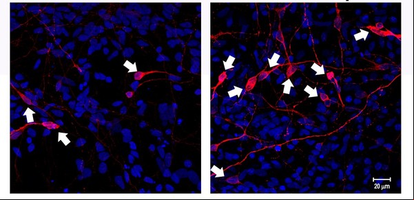 La ciencia trae dos buenas noticias para el tratamiento del Parkinson con células madre: seguridad y eficacia
