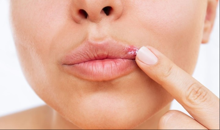 Un 13% se vería alcanzado por el tipo 2, labial o genital.