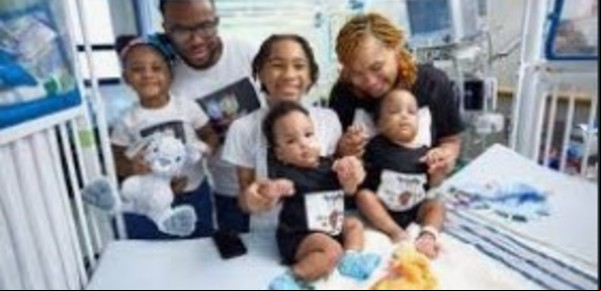 Exitosa cirugía de separación: siameses celebraron su primer cumpleaños