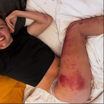 Una ciclista mostró sus brutales heridas tras una estremecedora caída en una carrera en Italia: "Siempre podría ser peor..."