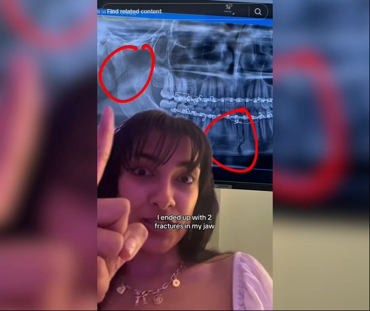 Ella exhibió una radiografía de su mandíbula, con las fracturas mencionadas. Foto: captura de video/TikTok @jawbreakergirl.