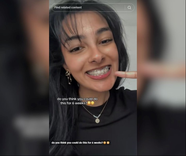 Los alambres que le habían colocado a la canadiense en su boca. Foto: captura de video/TikTok @jawbreakergirl.
