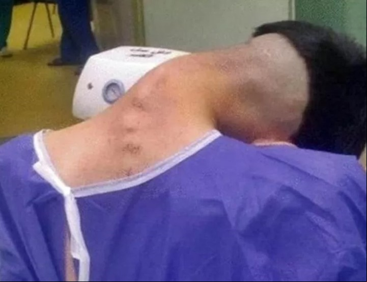El paciente de 23 años que fue operado con éxito (Universidad Médica de Isfahán, Irán).