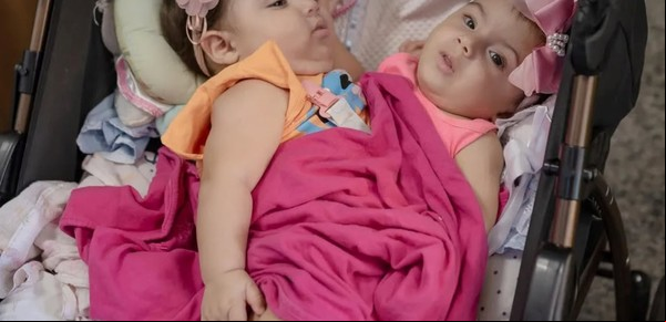 Kiraz y Aruna: logran separar a dos hermanas siamesas en una cirugía histórica